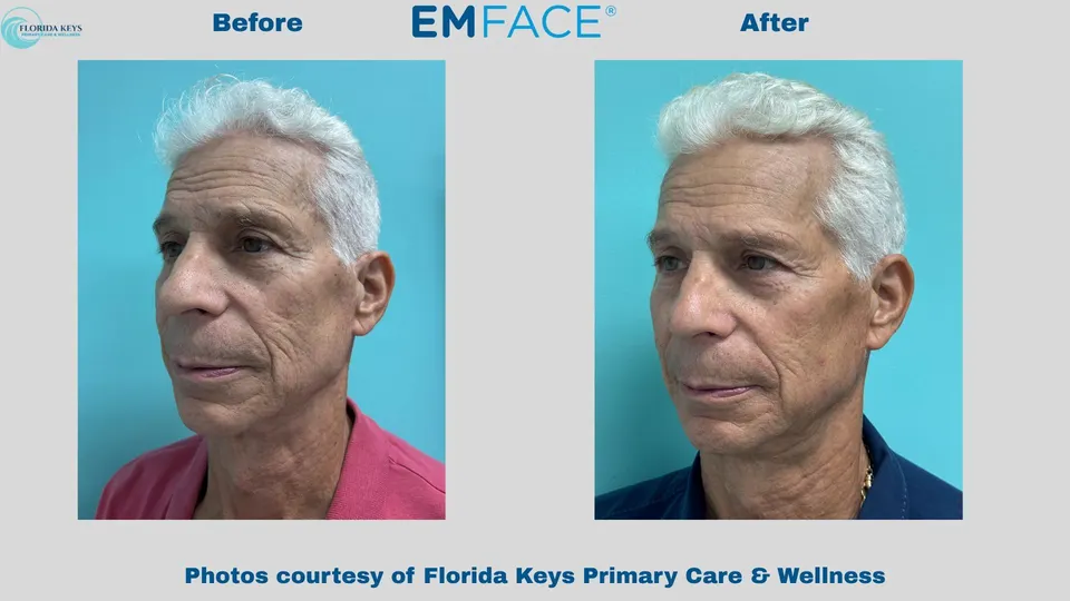Emface before and after