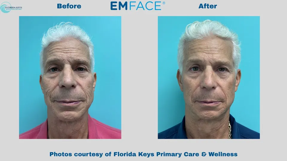 Emface in Big Pine Key, FL before and after
