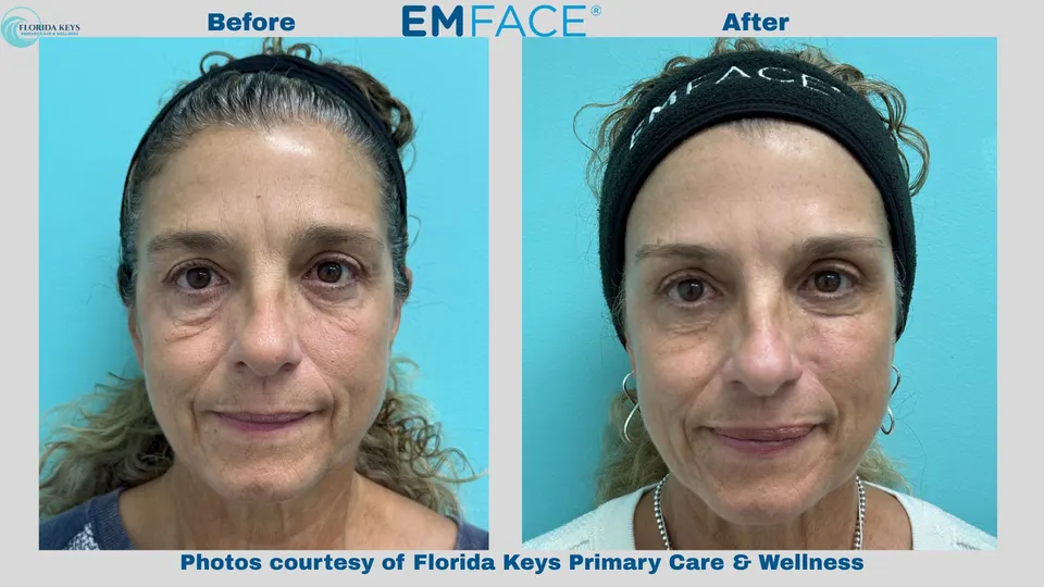 Emface in Big Pine Key, FL before and after