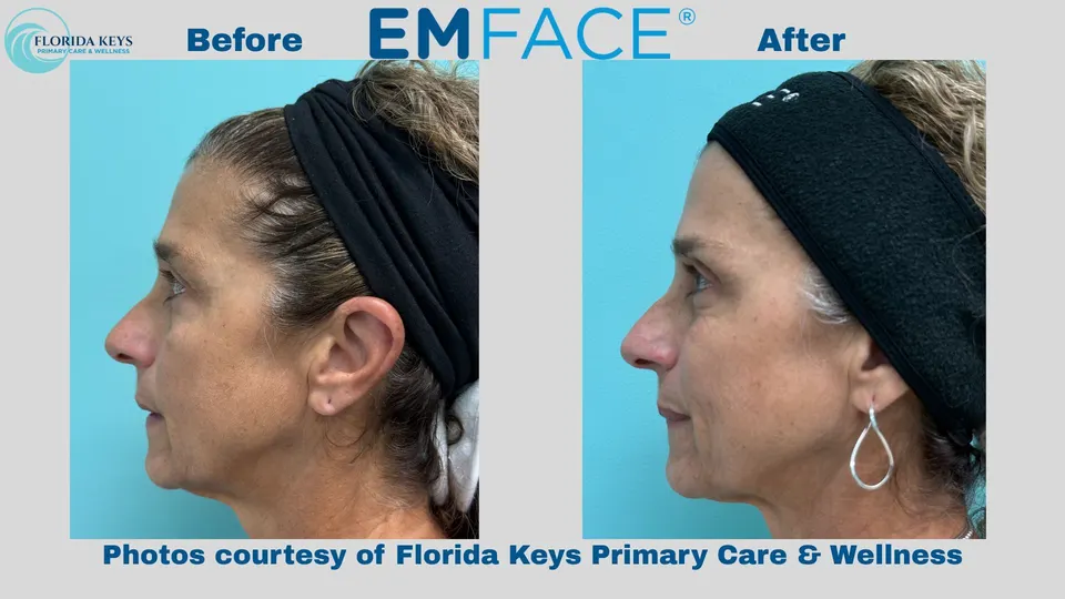 Emface in Big Pine Key, FL before and after