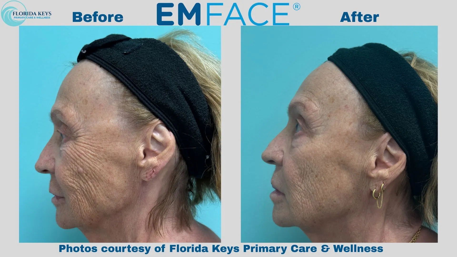 Emface in Big Pine Key, FL - Before and After