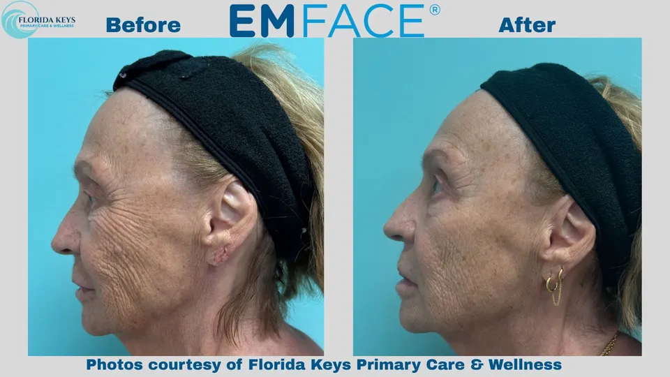 Emface in Big Pine Key, FL before and after
