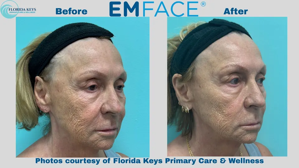 Emface in Big Pine Key, FL before and after