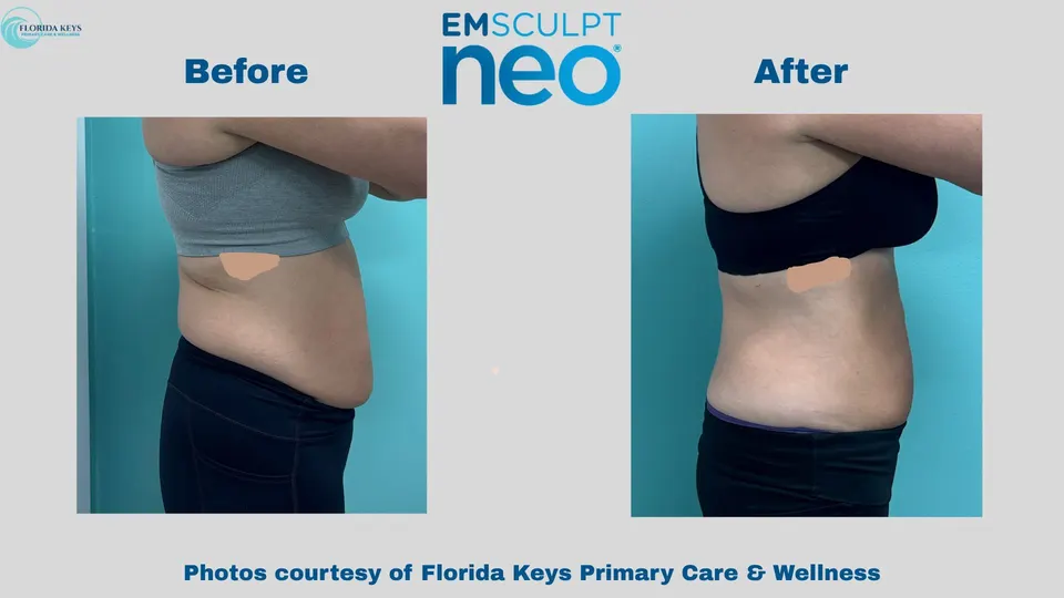 Emsculpt Neo in Big Pine Key, FL before and after