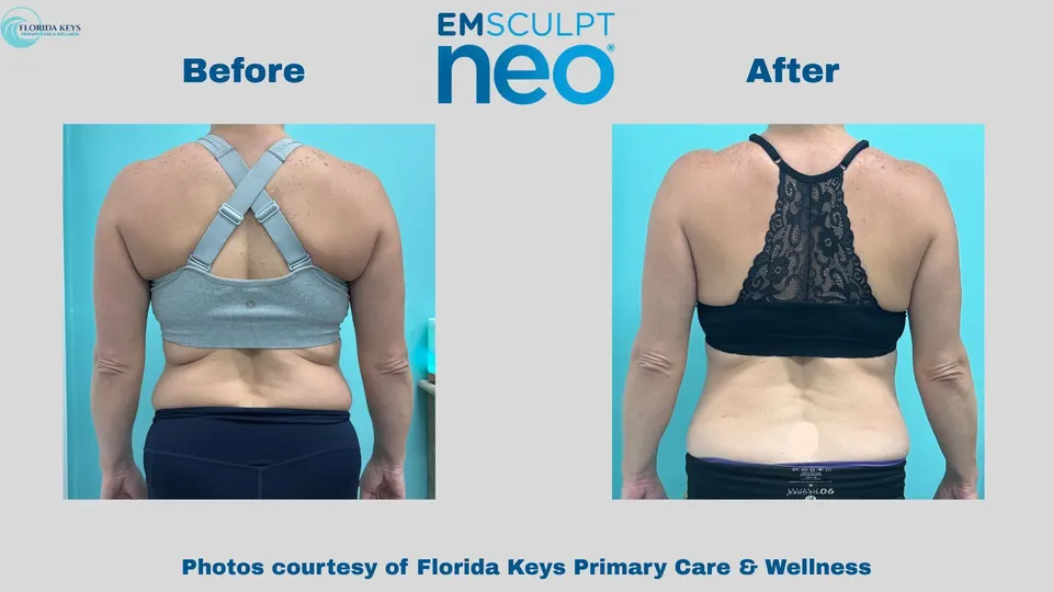 Emsculpt Neo in Big Pine Key, FL before and after