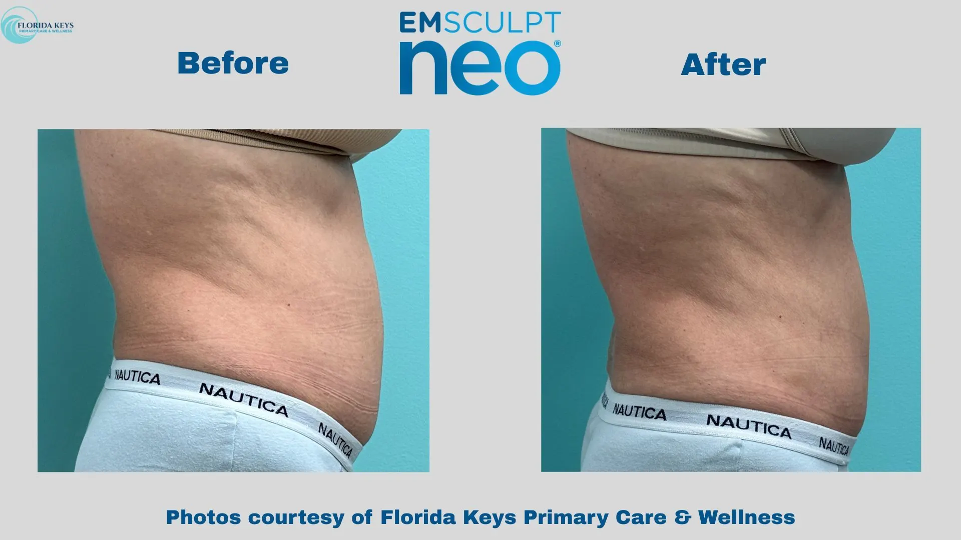 Emsculpt Neo in Big Pine Key, FL - Before and After