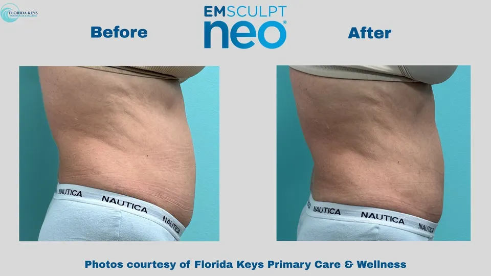 Emsculpt Neo in Big Pine Key, FL - Before and After