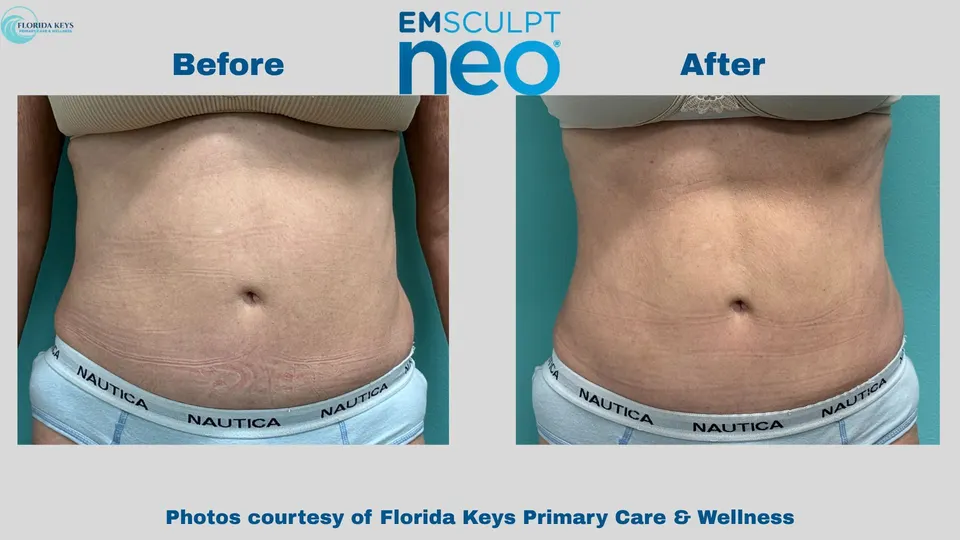 Emsculpt Neo in Big Pine Key, FL - Before and After
