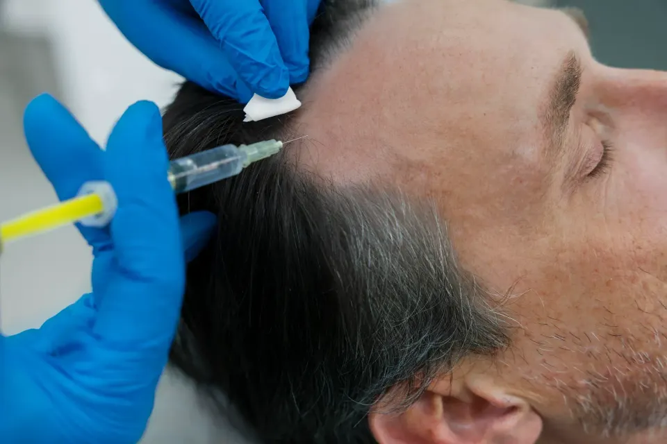 Patient receiving PRP hair restoration treatment at Florida Keys Primary Care & Wellness in Big Pine Key, FL