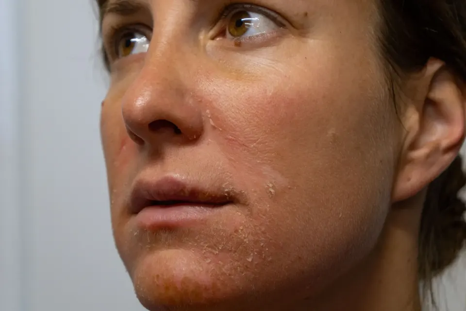 Patient examining sun damage and pigmentation in modern Florida Keys clinic