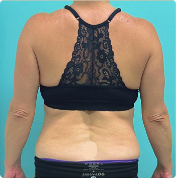 After Emsculpt Neo in Big Pine Key, FL