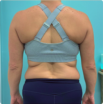 Before Emsculpt Neo in Big Pine Key, FL